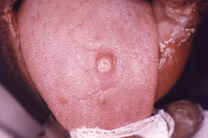 Image: Primary stage syphilis sore (chancre) on the surface of a tongue. Credit: CDC, 2012