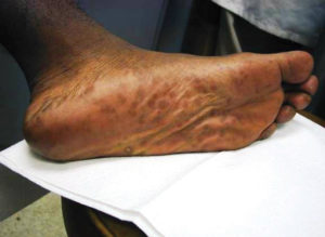 Syphilis rash on bottom of feet. Credit: CDC, 2012